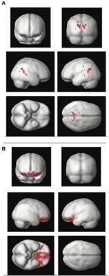 Effects of Systolic Blood Pressure on Brain Integrity in Multiple Sclerosis